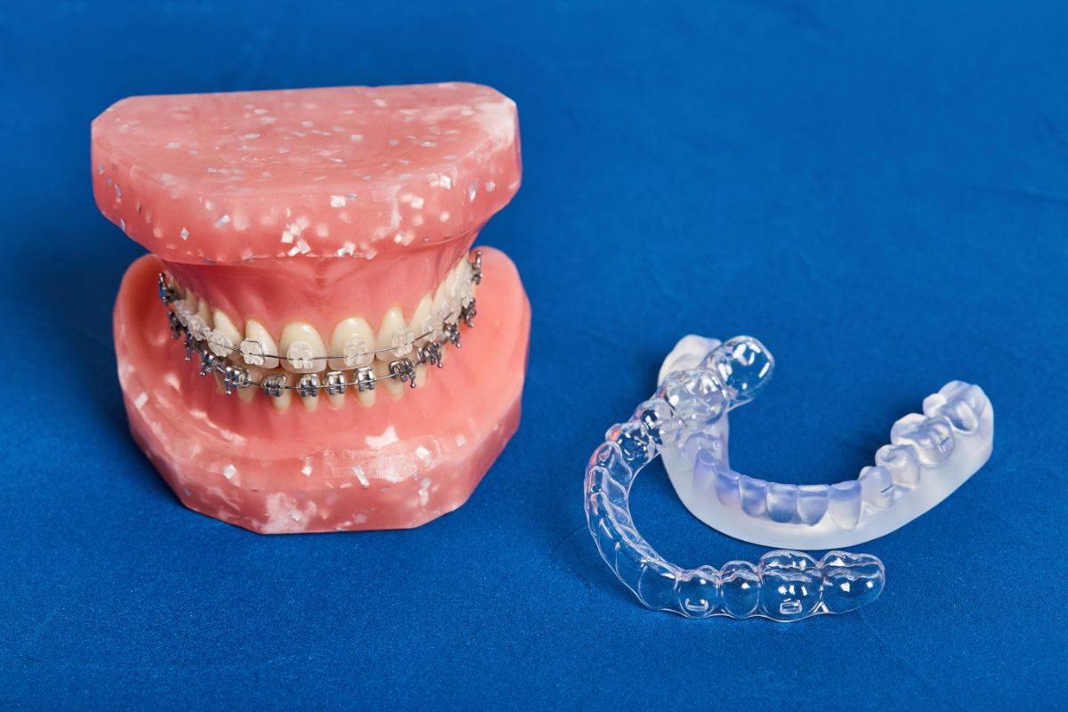 Everything You Need to Know About Palatal Expanders