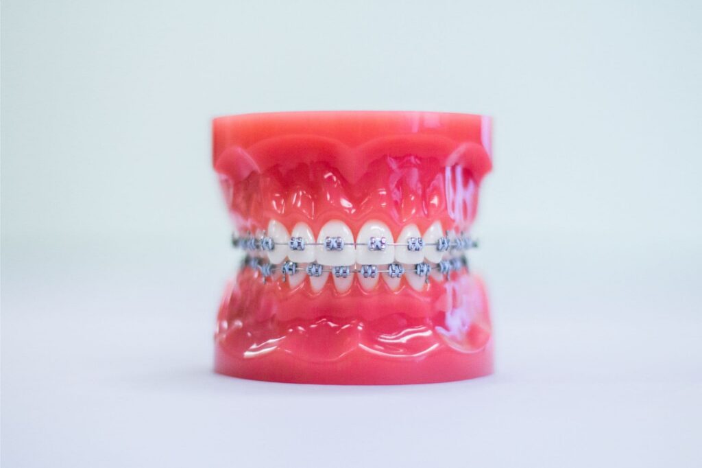 Metal braces model